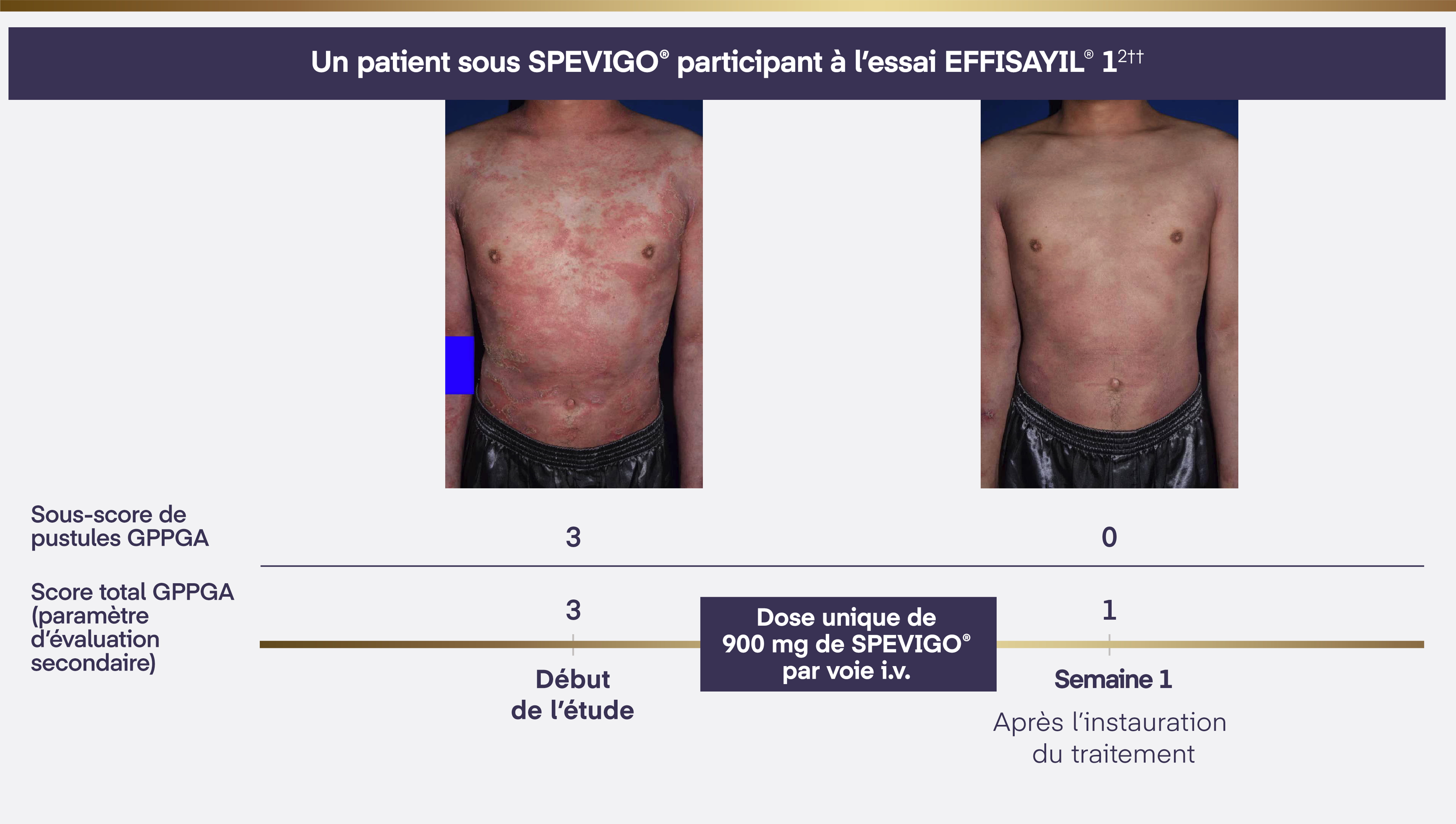 Deux images représentant des patients ayant reçu une dose unique de 900 mg de SPEVIGO® par voie i.v. après l'évaluation initiale. Ce patient avait un sous-score de pustules GPPGA de 3 au départ et de 0 à la semaine 1. Leur score total GPPGA (paramètre d'évaluation secondaire) était de 3 au départ et de 1 à la semaine 1.